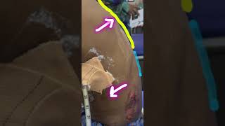 Flail chest  part 1  rib fracture  chest injury [upl. by Shuping]