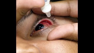 ¿Qué es la Conjuntivitis Cuáles son sus síntomas y cómo prevenirlo [upl. by Yarahs695]