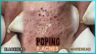 Big Cystic Acne Blackheads Extraction Blackheads amp Milia Whiteheads Removal Pimple Popping [upl. by Dor]