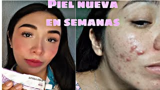 Tretinoina antes y despues manchas y acne● [upl. by Bullock]