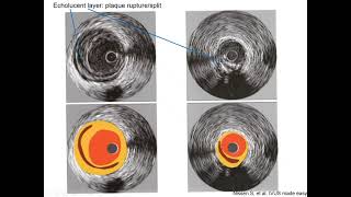 Intravascular ultrasound IVUS  Elias Hanna Univ of Iowa [upl. by Tawsha512]