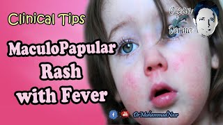 MaculoPapular Rash with Fever  Ocean Derma  Clinical Tips [upl. by Audly356]