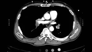 Acute massive pulmonary embolism with right heart strain CT Axial JETem 2017 [upl. by Ahsan512]