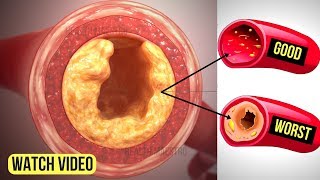 Just 3 Ingredients Will Unclog Your Arteries Without Medication and Reduce Cholesterol Fast [upl. by Anirtac260]