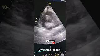 Whats your diagnosis 🤔 MedicalMystery Healthcare echocardiogram echocardiography heart [upl. by Yrocal]