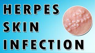 Herpes Simplex Virus Symptoms and Treatment [upl. by Lenad]