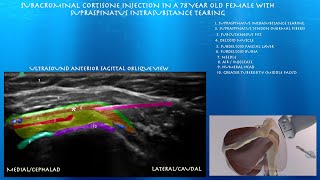 Ultrasound Guided Subdeltoid BursaSubacrominal Injection by probeultrasound [upl. by Lilian494]