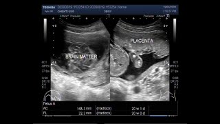 Ultrasound Video showing Anencephaly in a Pregnancy of about 20 weeks [upl. by Ayota]