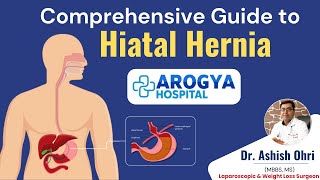 Comprehensive Guide to Hiatal Hernia  Types Symptoms and Treatment by Dr Ashish Ohri [upl. by Elleinaj]