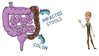 What Causes Constipation  The Dr Binocs Show  Best Learning Videos For Kids  Peekaboo Kidz [upl. by Silirama]