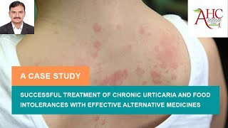 Urticaria or Hives Homeopathic Treatment  Dr Anwaar  چھپاکی  Homeo medicine [upl. by Karie]