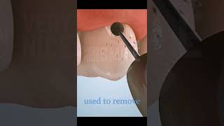 Fixing a Gum line Cavity short dentist teethwhitener [upl. by Romelle]