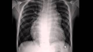 Chest xray  pulmonary arterial hypertension [upl. by Hardner]