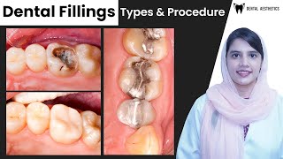 Dental Fillings Types and Procedures Explained  Dental Aesthetics [upl. by Hollis]