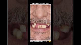 Missing Teeth Solution  Snap On Veneers shorts smiletransformation [upl. by Buckler586]