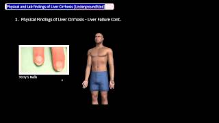 Physical and Lab Findings of Liver Cirrhosis UndergroundMed [upl. by Silrak360]