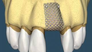 Implantes Dentários  Com Enxerto Ósseo [upl. by Granoff]