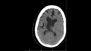 CT Chronic Basal Ganglia infarcts and Anatomy DISCUSSION by Radiologist [upl. by Debor]