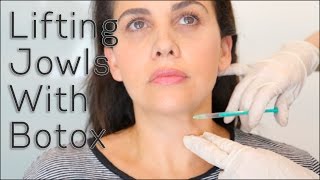 Lifting Jowls With Botox  BLUSH Beverly Hills [upl. by Alpert]