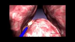 Quanta System  BPH  3D Enucleation median lobe  Thulium Laser [upl. by Assirac]