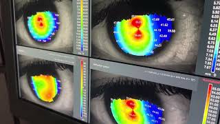 Corneal Topography With The Zeiss 500 Corneal Topographer [upl. by Church]