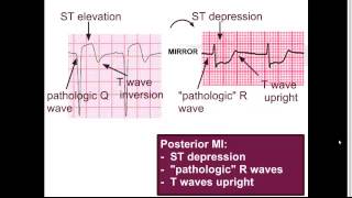 Posterior MI quotEM in 5quot [upl. by Asseral]