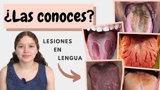 Lesiones en lengua  Lengua fisurada  Lengua vellosa  Glositis migratoria benigna [upl. by Amethist]