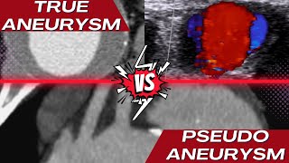 True Aneurysm vs Pseudoaneurysm [upl. by Ennairol]