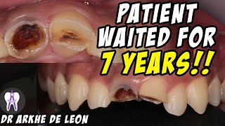 Amazing Case of Fractured Teeth Restored with Zirconia Crown 4k C29 [upl. by Fulcher153]