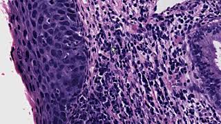 Severe Dysplasia of Cervix  CIN III Histopathology  Madeformedicalcom [upl. by Killigrew]