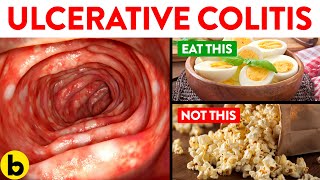 Foods You Should And Should Not Eat With Ulcerative Colitis [upl. by Eisoj]