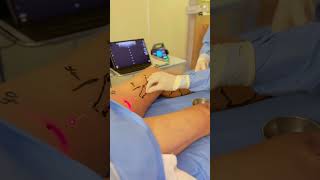 TRATAMENTO SE VARIZES COM LASER EM ARACAJU aracajusergipe medico varizes aracajuse [upl. by Nnyltiak774]