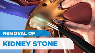 Removal of Kidney Stones Percutaneous Nephrolithotomy PCNL for Kidney Stones [upl. by Ahtekal]