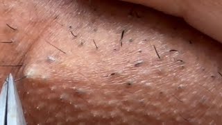 INGROWN HAIR REMOVAL 102  Longest Plucking Video Yet  DermaplaningEyebrow Shaving [upl. by Merlina]