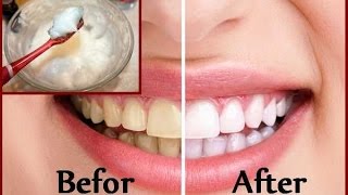 DIY Teeth Whitening at Home in 2 minutes [upl. by Harvey551]