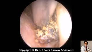 Top Biggest Ear Wax Removal 89  Ear wax Extraction  Dr S Thouk Earwax Specialist [upl. by Kauppi]