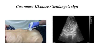 Острая кишечная непроходимость Ранний признак  Симптом Шланге [upl. by Celle]