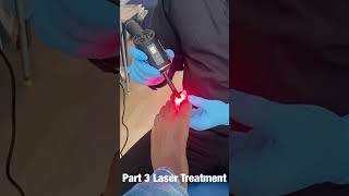 Toenail fungus laser treatment [upl. by Etienne141]