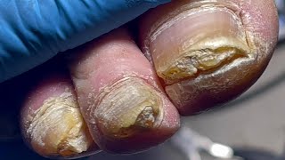 Thick nails every toenail infected with onychomycosis【Pedicure Master Lin Jun】 [upl. by Heise]