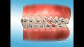 Advanced Orthodontics  Elastics [upl. by Felder]