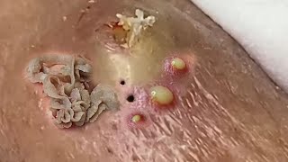 The Best Blackhead Cleaning Removal  Good Grooming Blackhead Removal 022 [upl. by Machutte401]