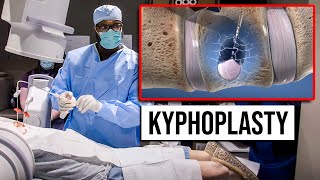 Kyphoplasty  Outpatient  Same Day Procedure for Vertebral Compression Fractures [upl. by Flossi]