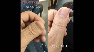 Stub thumb lengthening Toethumb Brachydactyly MegenFox Doctor thumb clubbedthumb [upl. by Anoynek]