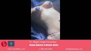 Mommy Makeover in Mexicali Mexico by Dr Miguel Angel Fernandez – Patient Testimonial [upl. by Xed]