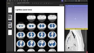 Segmentação e Análise do Parênquima pulmonar no 3D Slicer [upl. by Ahsikahs]