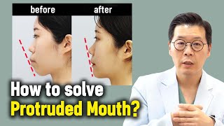 ENJP How to solve Protruded Mouth l Korean Protruded Mouth surgery case review [upl. by Latreese]