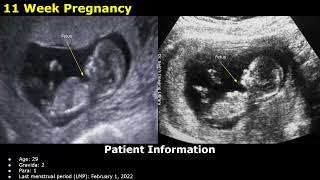 First Trimester Pregnancy Ultrasound Reporting  Obstetric USG Scan Reports  512 Weeks Fetal USG [upl. by Oranneg]