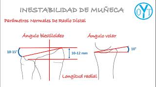 inestabilidad de muñeca [upl. by England834]