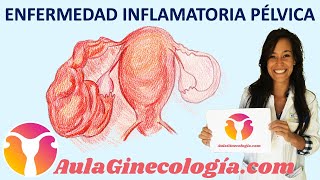 ENFERMEDAD INFLAMATORIA PÉLVICA EPI Síntomas y tratamiento  Ginecología y Obstetricia [upl. by Horodko971]