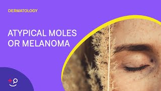 Atypical Moles or Melanoma The ABCDEs Dermatology [upl. by Enirehtacyram]